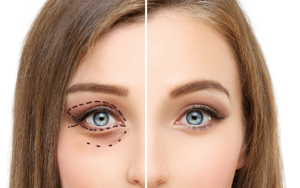 Cirugía de Párpados Superiores e Inferiores (Blefaroplastia)