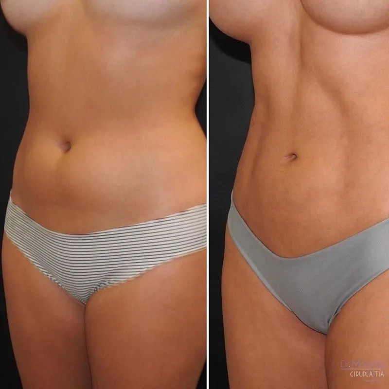 Lipolisis en bogotá Dr Jorge Poveda