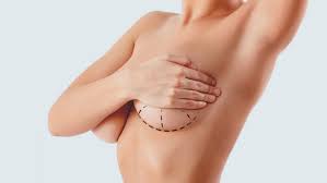 Elevación de los Senos (Pexia Mamaria)